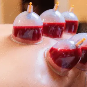 Hijama Cupping Therapy